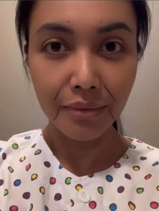 <p>Sebelum menjalani operasi di Korea Selatan, perempuan seorang anak itu telah melakukan berbagai pertimbangan. Salah satu yang menjadi alasannya adalah pipinya terlihat turun saat tak menggunakan make up.[Instagram/denadaindonesia]</p>