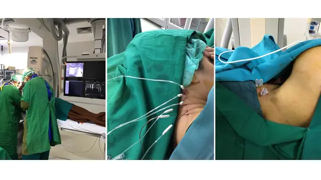 Dokumentasi tindakan Neurolysis Ablation dengan Radiofrequency