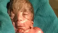 Betapa ironi, seorang bayi di Uttar Pradesh, India lahir dengan kondisi langka yang disebut sirenomelia atau Mermaid Syndrome. 