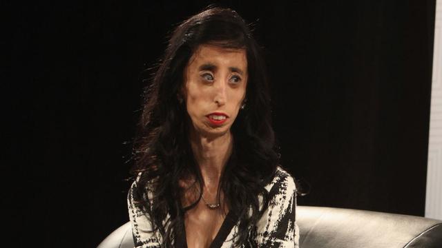 Derita Penyakit Langka Lizzie Jadi Wanita Terjelek Di Dunia Health Liputan6 Com