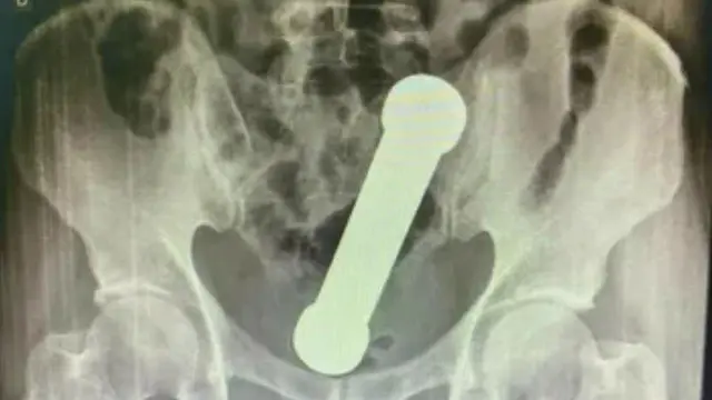 Enggak Habis Pikir, Dumbbell 2kg Tersangkut di Anus Pria Ini