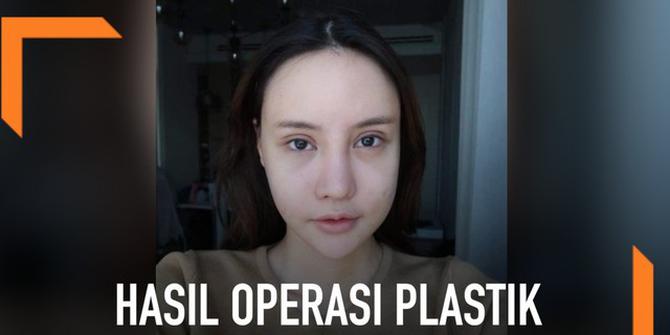 VIDEO: Transformasi Wajah Usai Operasi Plastik, Hasilnya Menakjubkan
