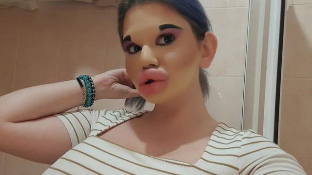 Ingin Tampil Bak Boneka, Wanita Akan Injeksi Bibir Ke 27 Kali Akhir Tahun Ini