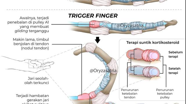Mengenal Trigger Finger, Jari Tertekuk yang Banyak Dialami Diabetesi