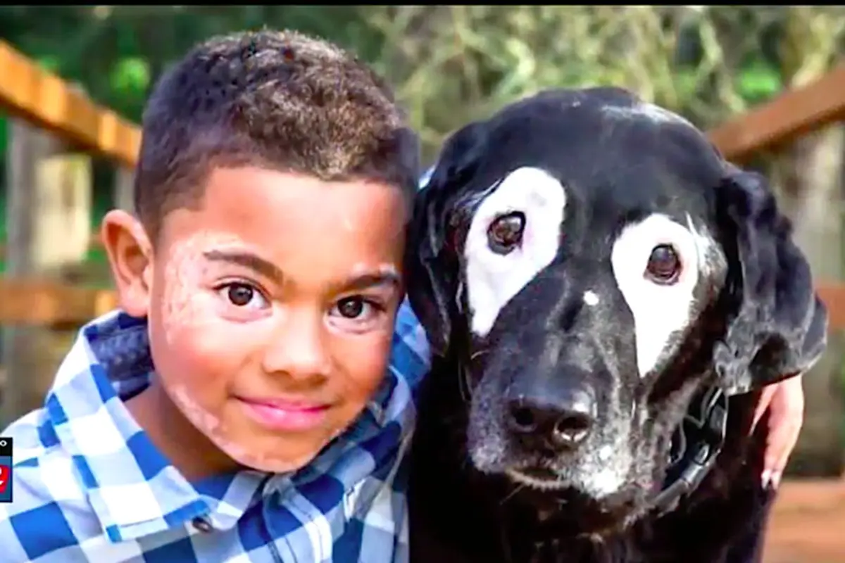 Vitiligo
