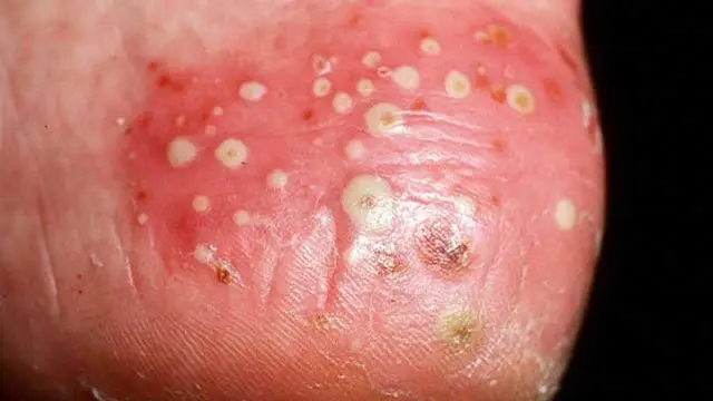 Psoriasis pustular