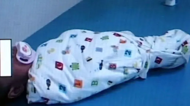 Bayi Kembar Siam Usia 2 Pekan Berhasil Dipisahkan