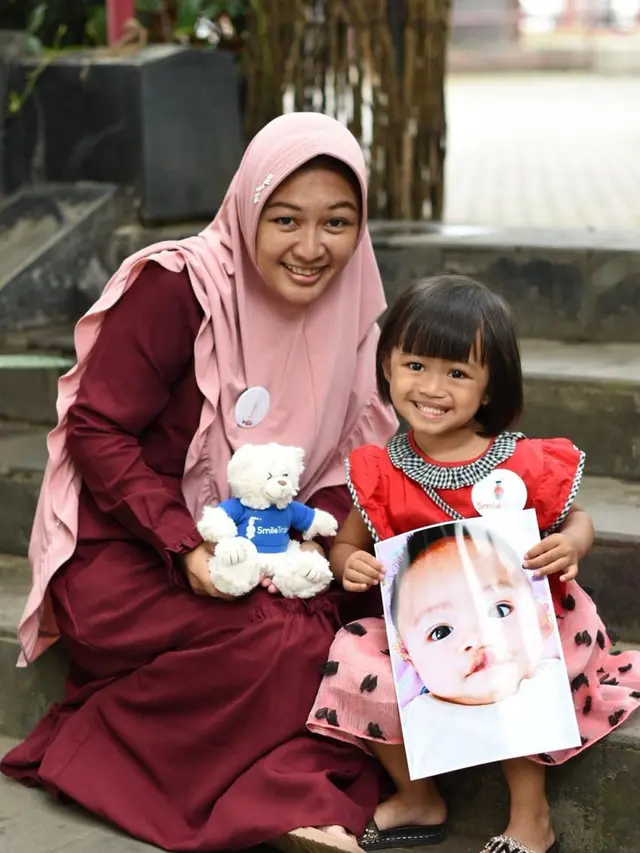 Setop Bullying Penyintas Bibir Sumbing