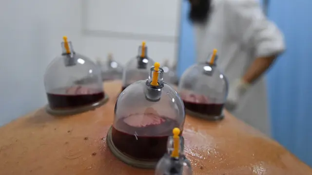 Melihat Pengobatan Bekam di Uni Emirat Arab