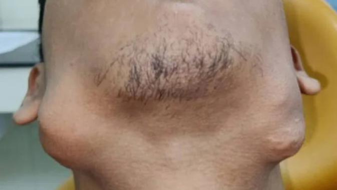 Derita Tumor Langka, Pria Ini Miliki 82 Gigi dalam Mulutnya - Vimarsana News