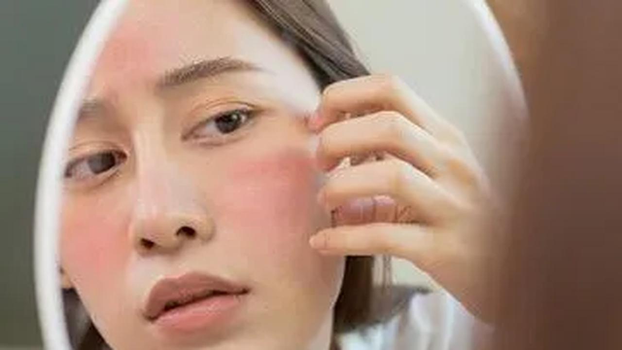 Cara Mengatasi Muka Gatal-Gatal