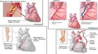 Meski Sudah Bypass, Pasien Jantung Tetap Harus Jalani Hidup Sehat
