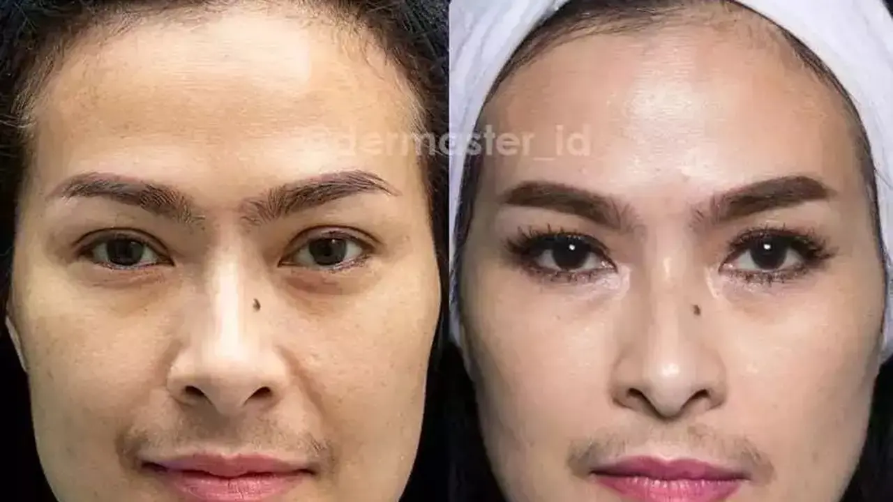 Potret Iis Dahlia sebelum dan sesudah tanam benang (Sumber: Instagram/dermaster_id)