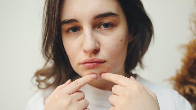 Ilustrasi wajah berjerawat