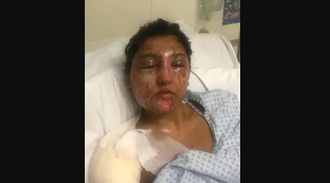 Kondisi Resham Khan saat pasca-penyerangan air keras (GOFUNDME)