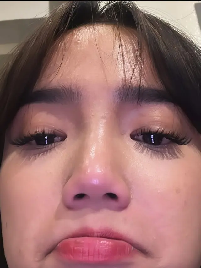 Fuji An Sedih Setelah Didiagnosis Skoliosis dan Mengetahui Tulang Belakang Miring. Skoliosis Adalah Kondisi Tulang Belakang Mengalami Kemiringan Sehingga Membentuk Huruf S atau C (instagram.com/fuji_an)