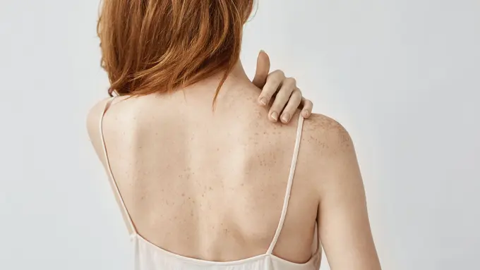 back acne