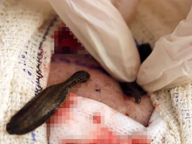 Seorang perawat menempatkan lintah pada luka di kaki pasien di rumah sakit CHU Pellegrin di Bordeaux, Prancis, (23/11). Lintah untuk terapi ini menggunakan lintah jenis Hirudo Medicinalis. (REUTERS / Regis Duvignau)