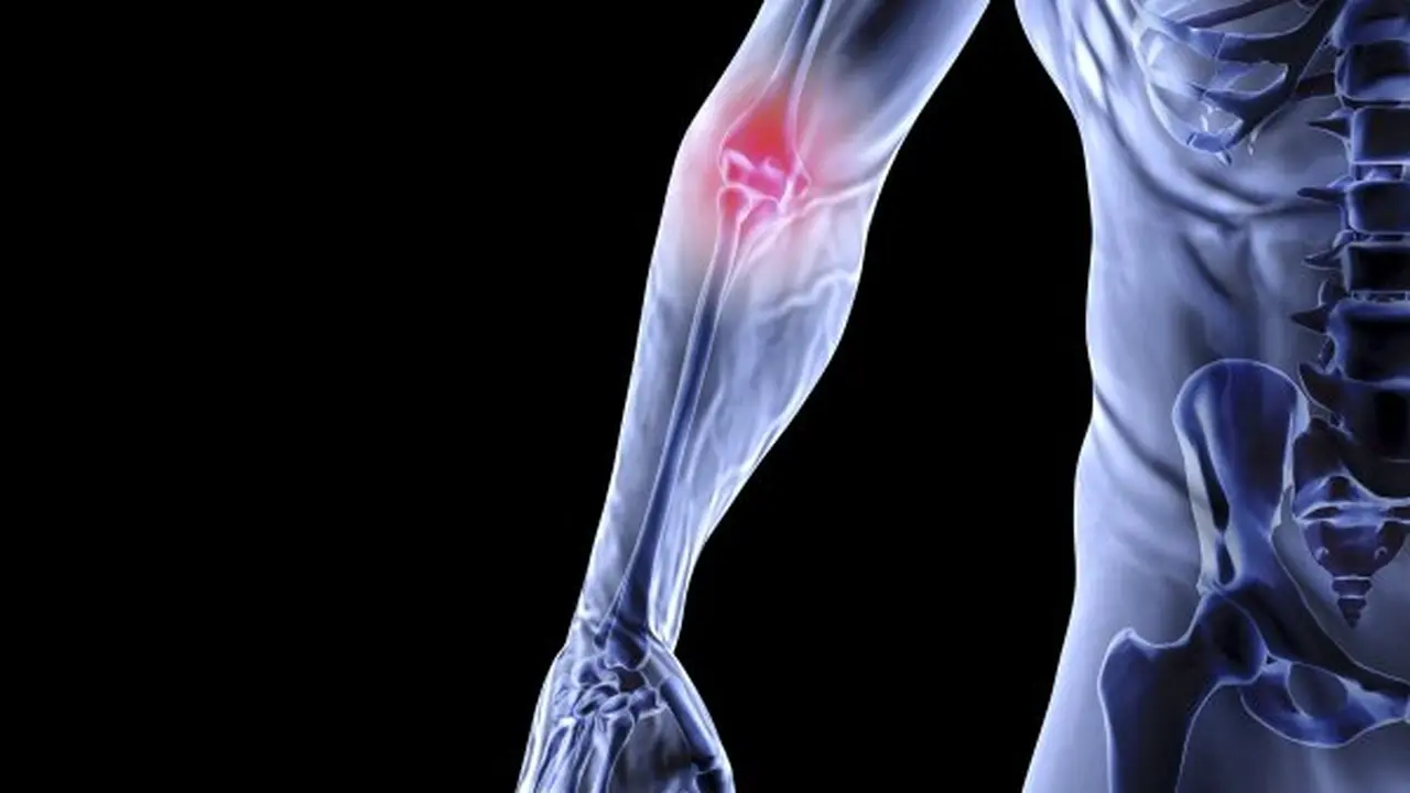 Mengenal Penyakit Osteoporosis pada Wanita