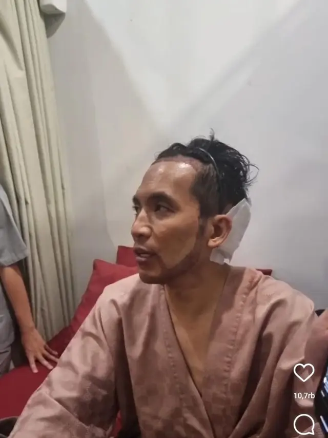 Desta jalani transplantasi rambut. (Instagram/ beyoutifulhairtransplantcenter)