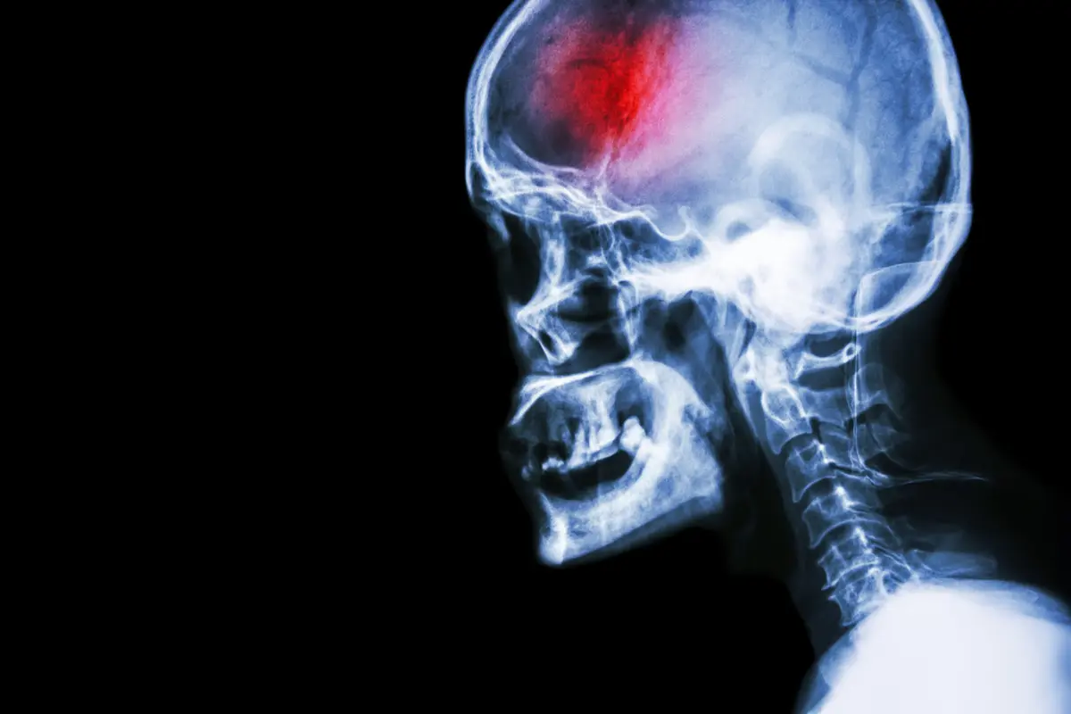Ilustrasi stroke (iStockphoto)