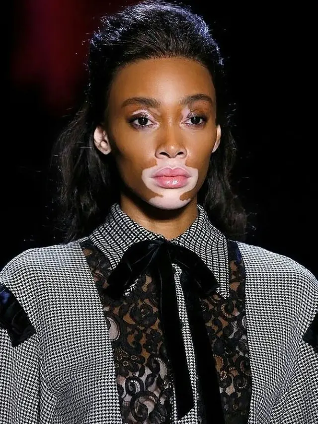 Vitiligo Sebabkan Depresi, Dukungan Positif Bisa Mempercepat Penyembuhan