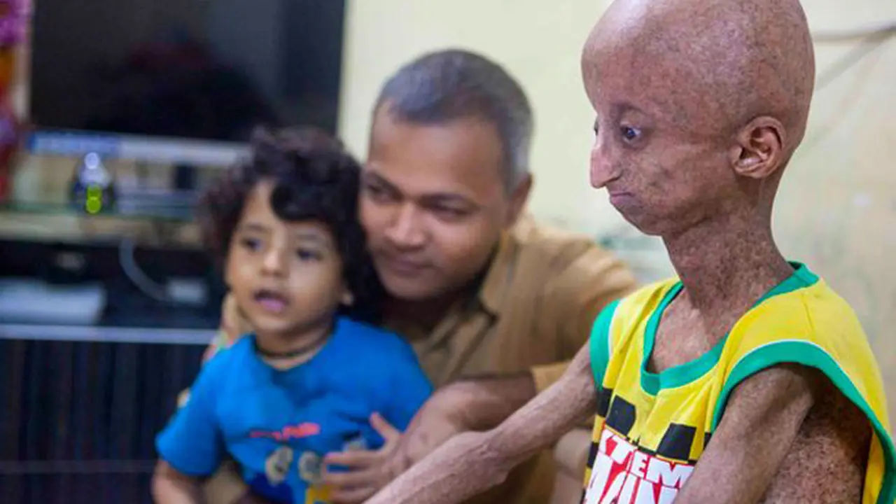 Enam Bocah di Dunia Ini Bertubuh Layaknya Kakek Nenek