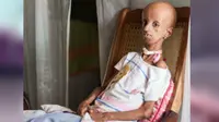 Hutchinson-Gilford Progeria Syndrome yakni kelainan genetik langka yang menyebabkan anak-anak mengalami penuaan diri scara berlebihan.