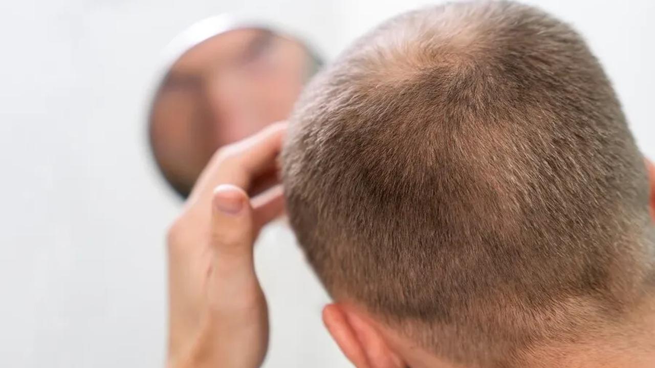 Pengikatan rambut terlalu ketat juga dapat menyebabkan kerusakan pada folikel rambut.<br>