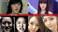 Saudara Kembar Berdagu Maju Dipermak Jadi `Boneka Barbie`