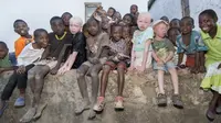 Bagian tubuh orang albino dipercaya dapat membawa kekayaan, kebahagiaan, dan keberuntungan (Amnesty/CNN).