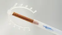 Ilustrasi alat KB IUD atau spiral (iStockphoto)