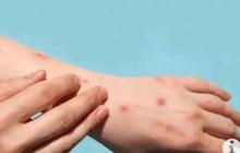 Tragis, Santri di Meranti Meninggal Diduga Terinfeksi Cacar Monyet: Waspadai Gejala Awal!