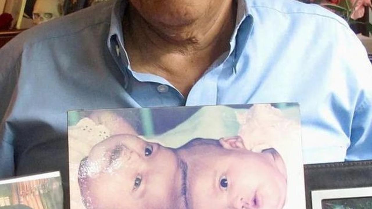 Dokter Padmo membawa foto Ana dan Ani sebelum operasi pemisahan kepala dilakukan