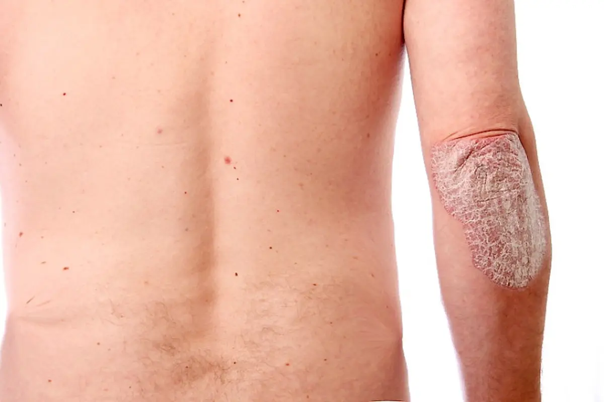 Apa Sih Psoriasis Itu?