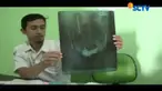 Sempat dinyatakan membaik, pria pemakan paku, Wawan, dinyatakan meninggal dunia Kamis (9/11) dini hari.