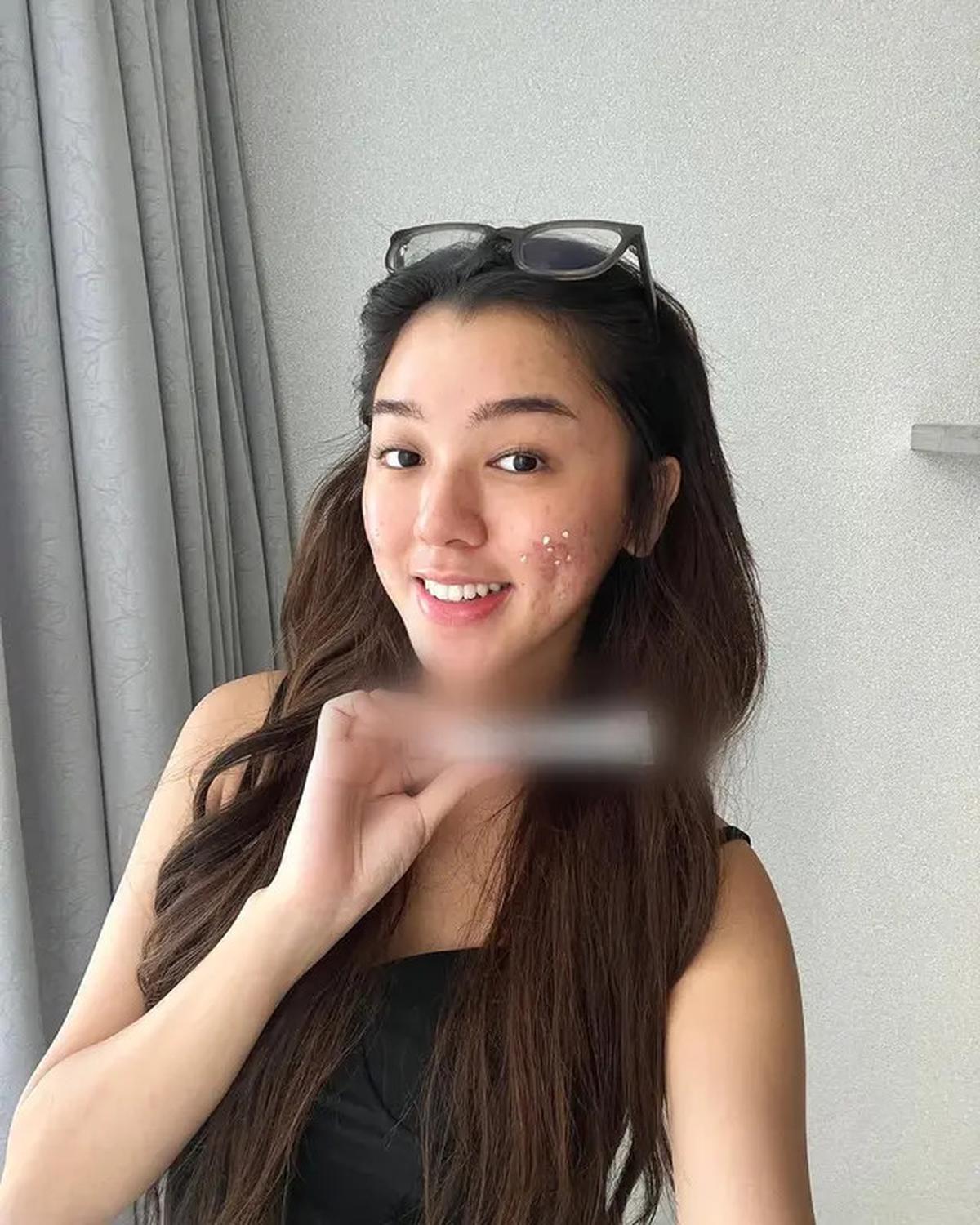 6 Potret Wajah Gabriella Ekaputri Berjerawat, Tetap Percaya Diri Tampil Natural