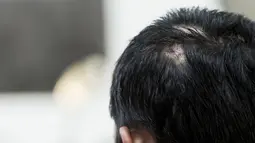 Khin Khin Tun memperlihatkan Bekas luka di kepalanya saat ia meninggalkan gedung pengadilan di Mawlamyine (13/2). Khin Khin Tun disiksa oleh majikannya yang bernama  Aye Aye Soe tega. (AFP PHOTO/YE AUNG THU)