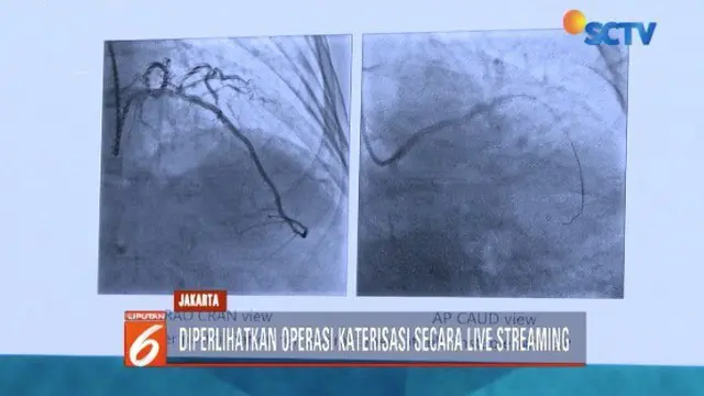 Kini, operasi jantung di Indonesia tak lagi memerlukan proses pembedahan. Sudah ada proses operasi katerisasi.