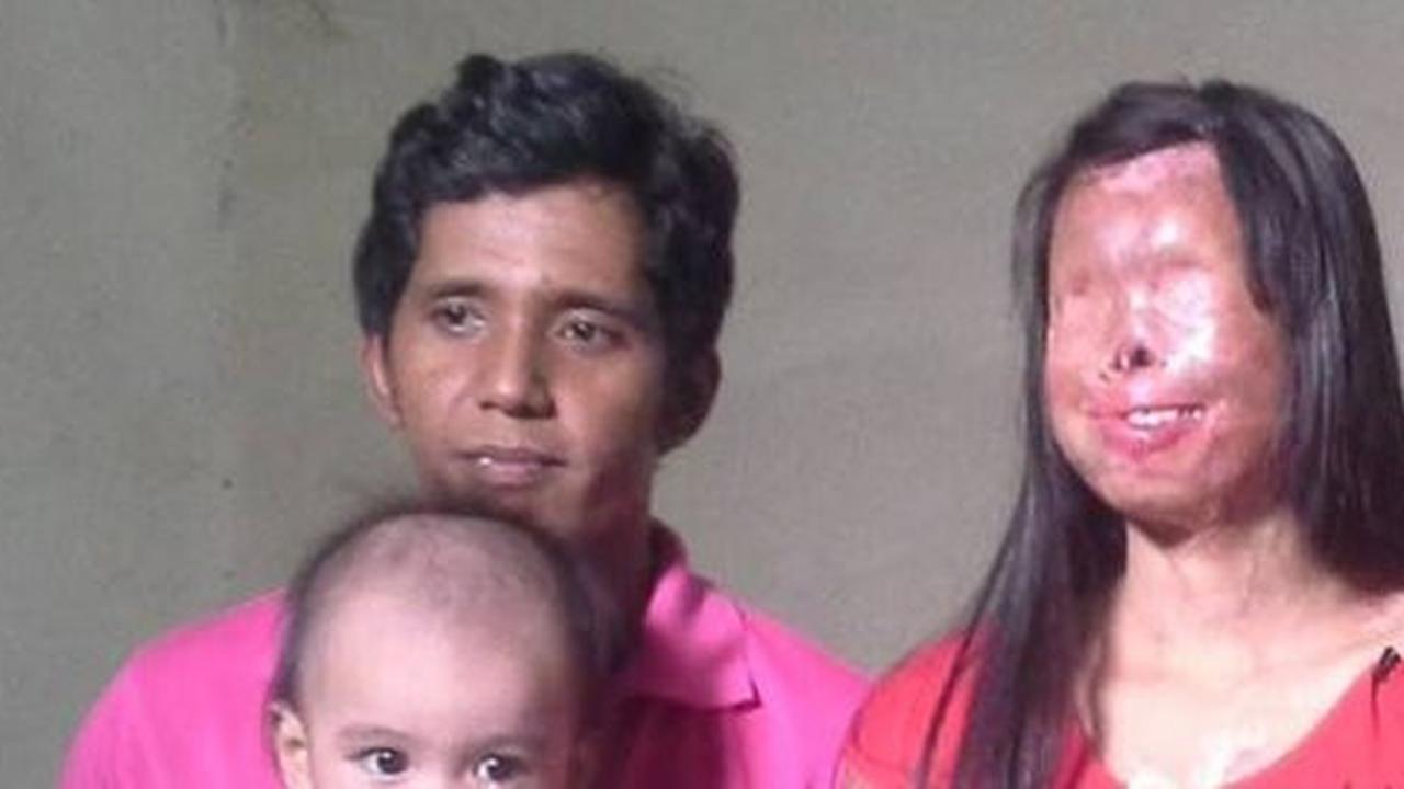 Suami ini tetap setia meski sang istri alami luka bakar parah