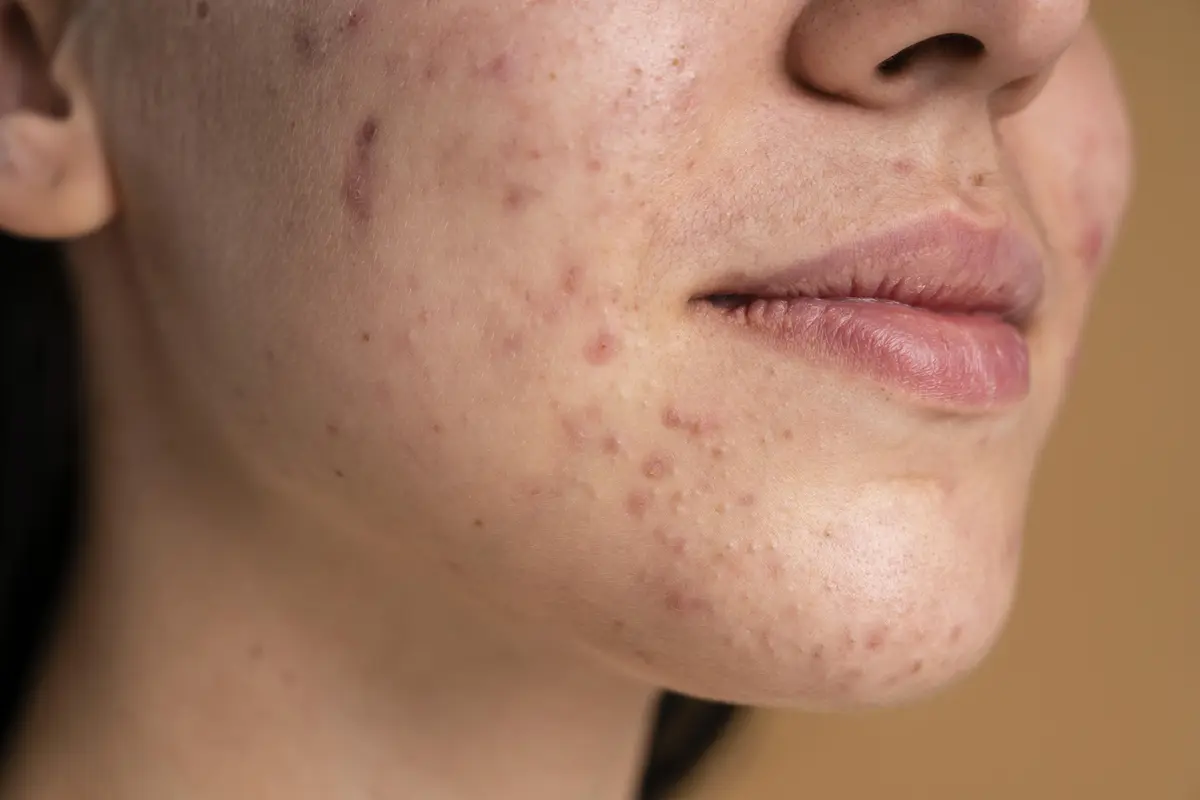 Tak Perlu Panik! Ini Cara Menenangkan Kulit Berjerawat Dengan Skincare [Dok/freepik.com[