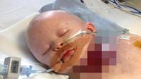 Carlie bayi laki-laki berusia 13 bulan ini hampir meninggal akibat infeksi cacar air di lehernya.