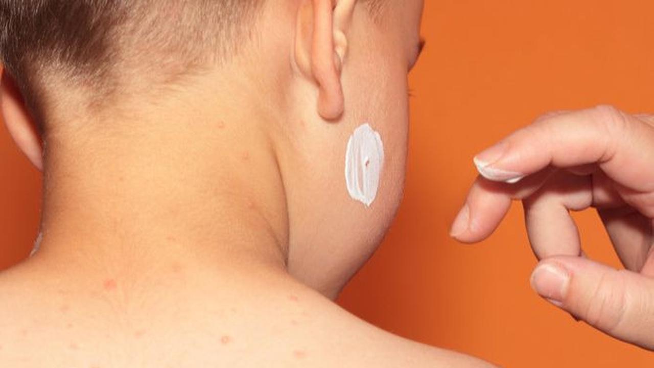 Gejala cacar air meliputi: