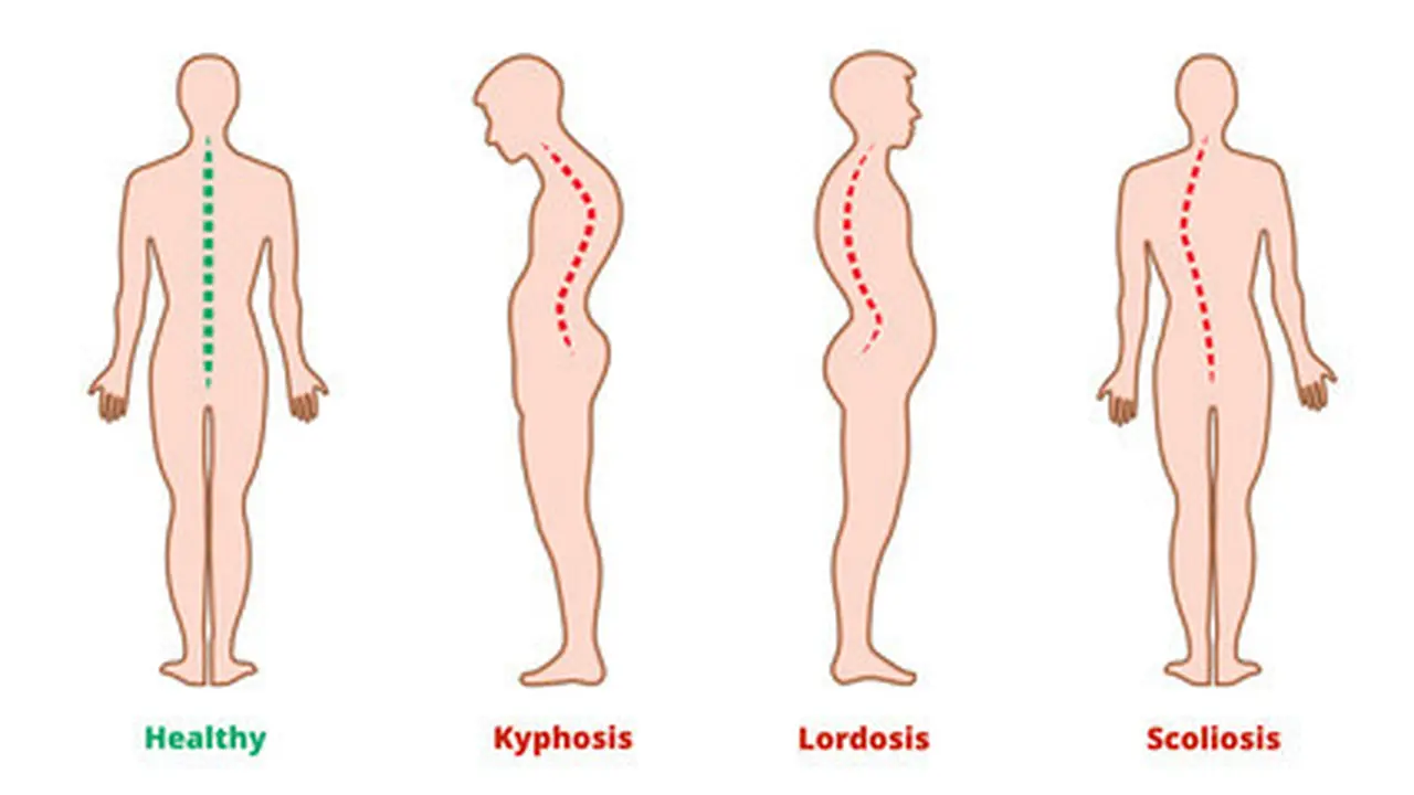 Kelainan Tulang Skoliosis, Kifosis, dan Lordosis
