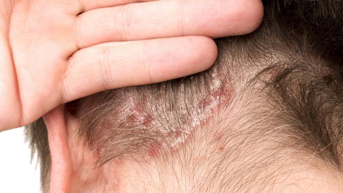 Gangguan Pada Kulit Bisa Jadi Tanda 5 Penyakit Lain Health