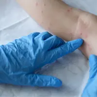 Ilustrasi cacar. (Unsplash/Ivan-balvan)