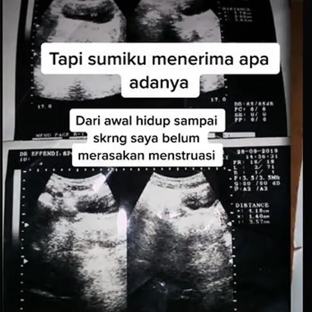 Cerita Haru Wanita 22 Tahun yang Mengaku Belum Pernah Menstruasi