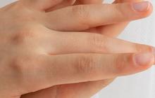 7 Tanda Seseorang Kurang Vitamin B12, Bisa Dilihat dari Telapak Tangan