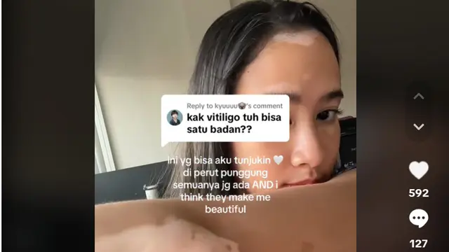 Konsumsi suplemen herbal yang didapat dari MLM, dokter ini kena Vitiligo. Foto: tangkapan layar TikTok @salmakyn.