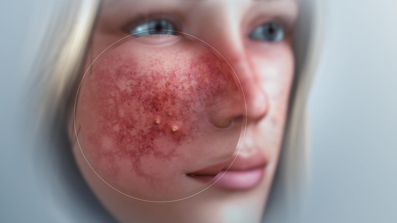 Sering Disangka Jerawat: Cara Efektif Menangani dan Membedakan Rosacea yang Sering Keliru Dianggap Jerawat